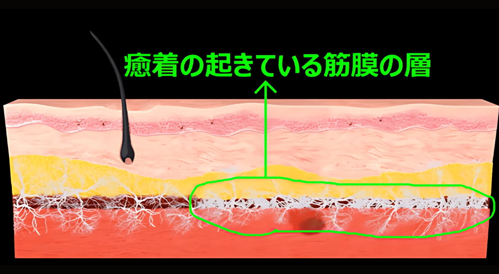 北浦和で肩こり改善におすすめの整体院-北浦和肩こり専門整体院の徒手筋膜リリーステクニック‐画像17